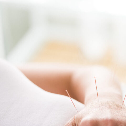Photo of woman having acupuncture treatment. Alternative Medicine.