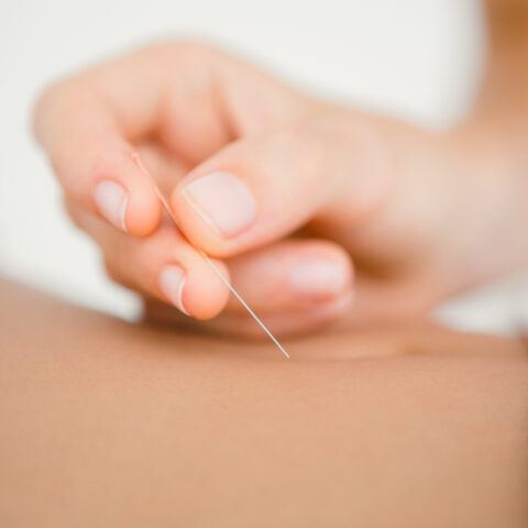 Close up view of woman holding a needle in an acupuncture therapy